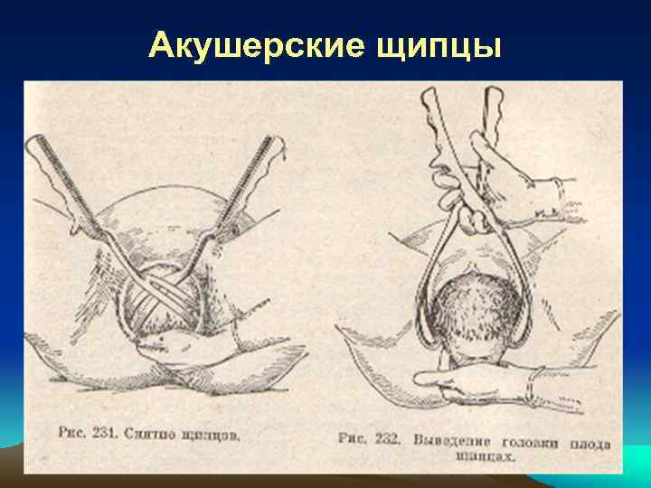 Акушерские щипцы 