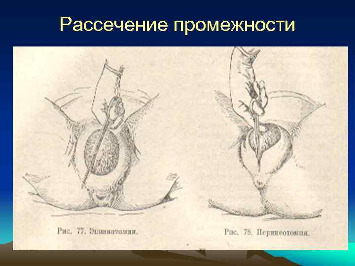 Рассечение промежности 