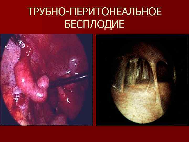 ТРУБНО-ПЕРИТОНЕАЛЬНОЕ БЕСПЛОДИЕ 