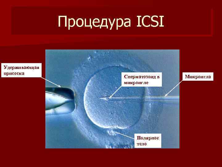Процедура ICSI Удерживающая присоска Сперматозоид в микроигле Полярное тело Микроигла 