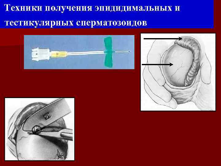 Техники получения эпидидимальных и тестикулярных сперматозоидов 