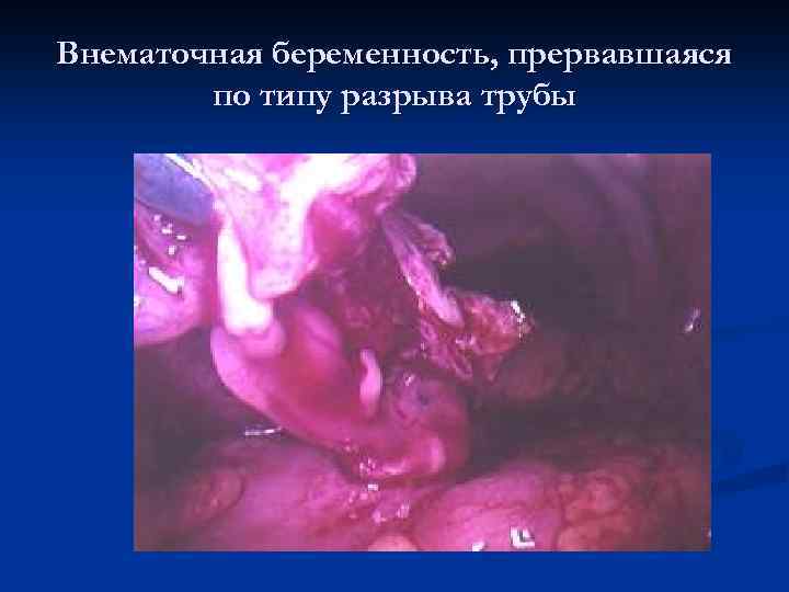 Внематочная беременность, прервавшаяся по типу разрыва трубы 