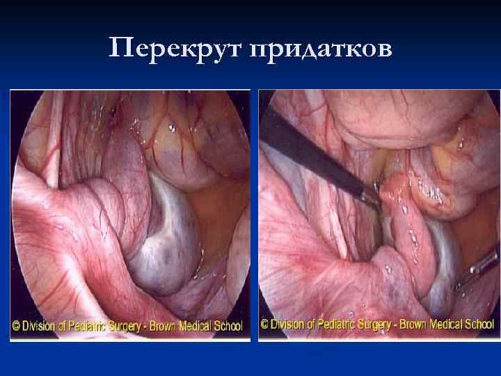 Перекрут придатков 
