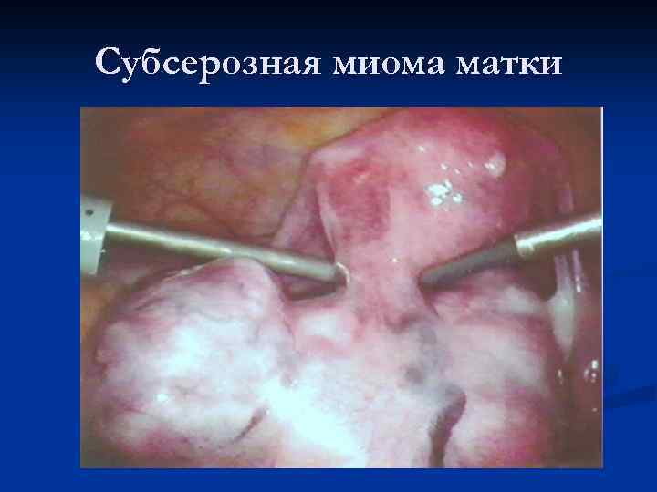 Субсерозная миома матки 