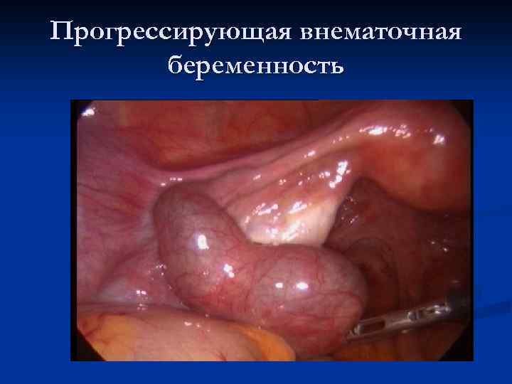 Прогрессирующая внематочная беременность 