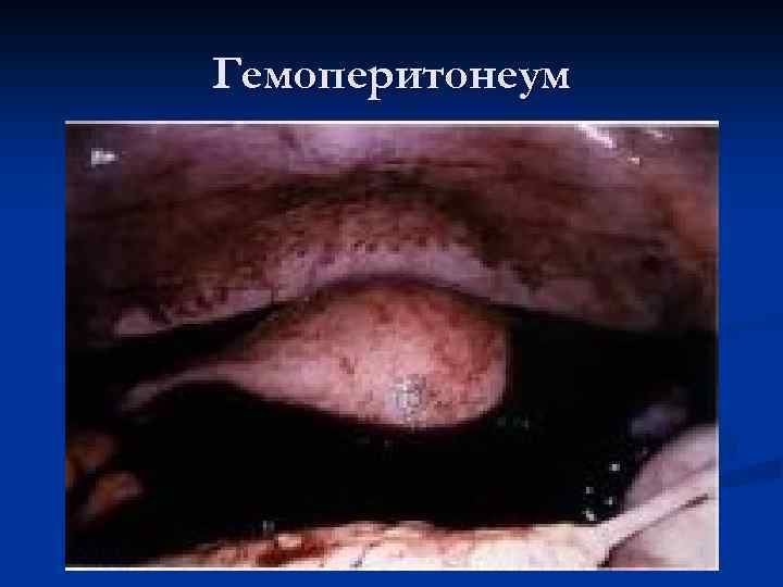 Гемоперитонеум 