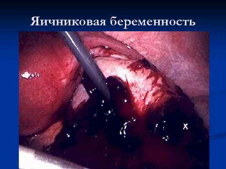 Яичниковая беременность 