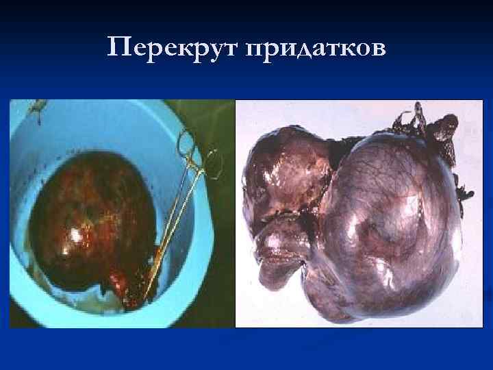Перекрут придатков 