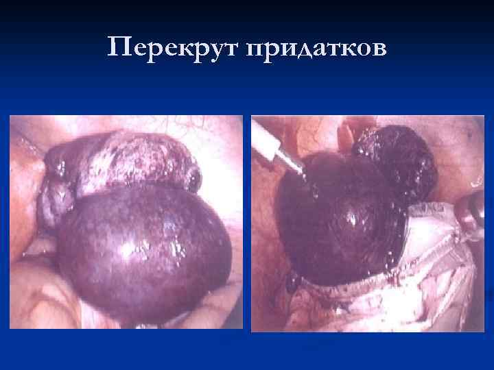 Перекрут придатков 