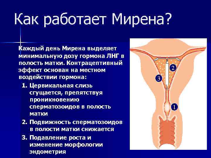 Как работает Мирена? Каждый день Мирена выделяет минимальную дозу гормона ЛНГ в полость матки.