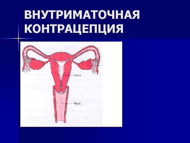 ВНУТРИМАТОЧНАЯ КОНТРАЦЕПЦИЯ 