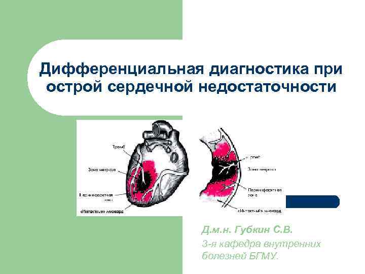 Дифференциальная диагностика при острой сердечной недостаточности Д. м. н. Губкин С. В. 3 -я