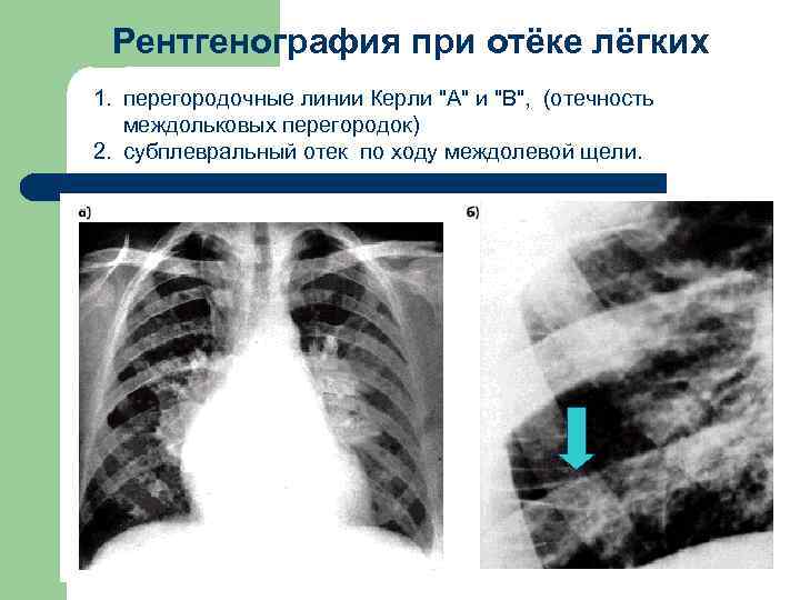 Рентгенография при отёке лёгких 1. перегородочные линии Керли 