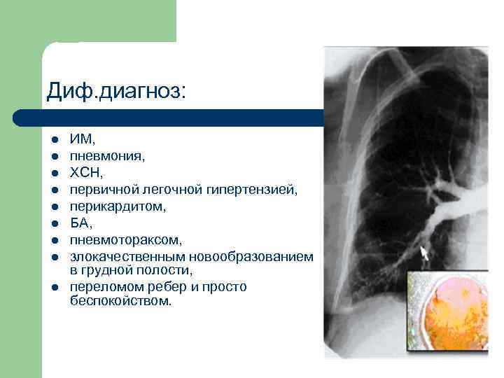 Диф. диагноз: l l l l l ИМ, пневмония, ХСН, первичной легочной гипертензией, перикардитом,