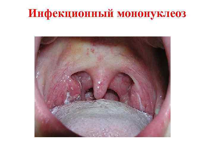 Инфекционный мононуклеоз 