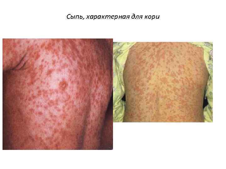 Сыпь, характерная для кори 