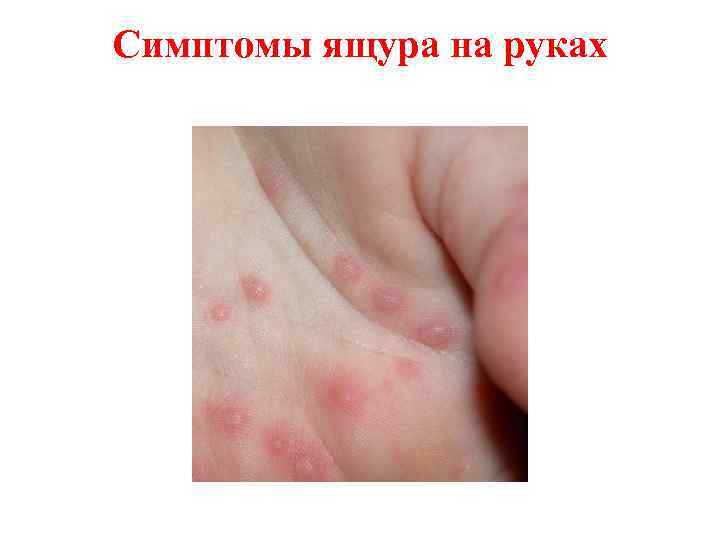 Симптомы ящура на руках 