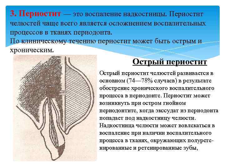 3. Периостит — это воспаление надкостницы. Периостит челюстей чаще всего является осложнением воспалительных процессов