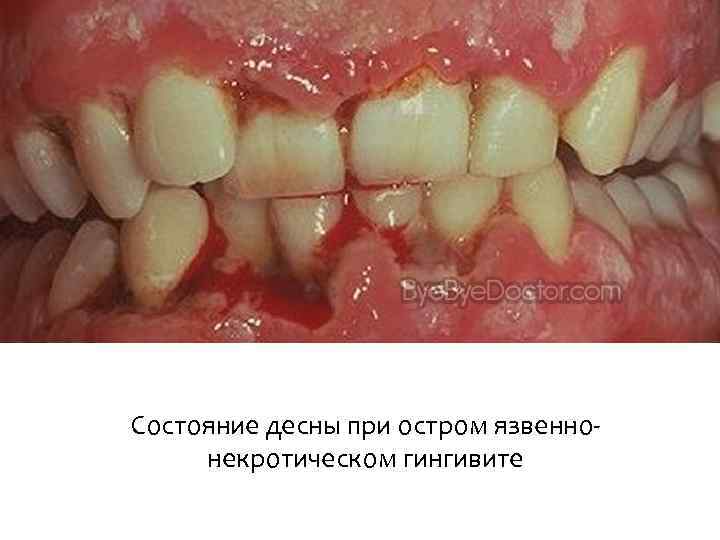 Состояние десны при остром язвеннонекротическом гингивите 