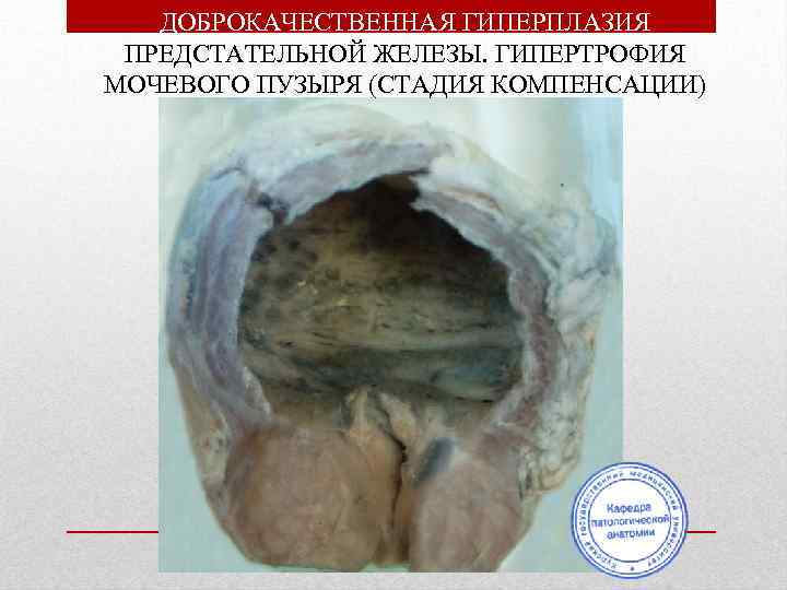 ДОБРОКАЧЕСТВЕННАЯ ГИПЕРПЛАЗИЯ ПРЕДСТАТЕЛЬНОЙ ЖЕЛЕЗЫ. ГИПЕРТРОФИЯ МОЧЕВОГО ПУЗЫРЯ (СТАДИЯ КОМПЕНСАЦИИ) 