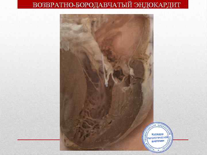 ВОЗВРАТНО-БОРОДАВЧАТЫЙ ЭНДОКАРДИТ 
