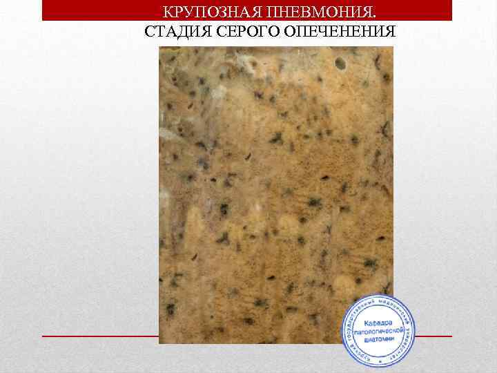 КРУПОЗНАЯ ПНЕВМОНИЯ. СТАДИЯ СЕРОГО ОПЕЧЕНЕНИЯ 