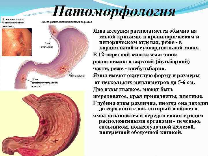 Патоморфология Язва желудка располагается обычно на малой кривизне в препилорическом и пилорическом отделах, реже