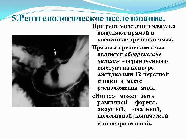 5. Рентгенологическое исследование. При рентгеноскопии желудка выделяют прямой и косвенные признаки язвы. Прямым признаком