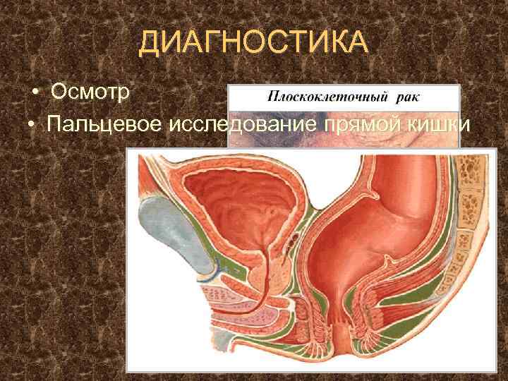 ДИАГНОСТИКА • Осмотр • Пальцевое исследование прямой кишки 