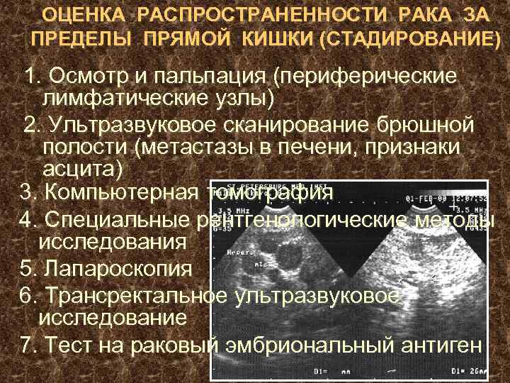 ОЦЕНКА РАСПРОСТРАНЕННОСТИ РАКА ЗА ПРЕДЕЛЫ ПРЯМОЙ КИШКИ (СТАДИРОВАНИЕ) 1. Осмотр и пальпация (периферические лимфатические