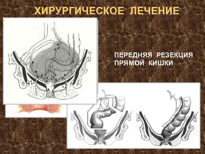 ХИРУРГИЧЕСКОЕ ЛЕЧЕНИЕ ПЕРЕДНЯЯ РЕЗЕКЦИЯ ПРЯМОЙ КИШКИ 