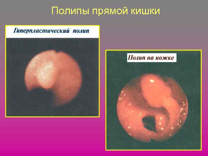 Полипы прямой кишки 