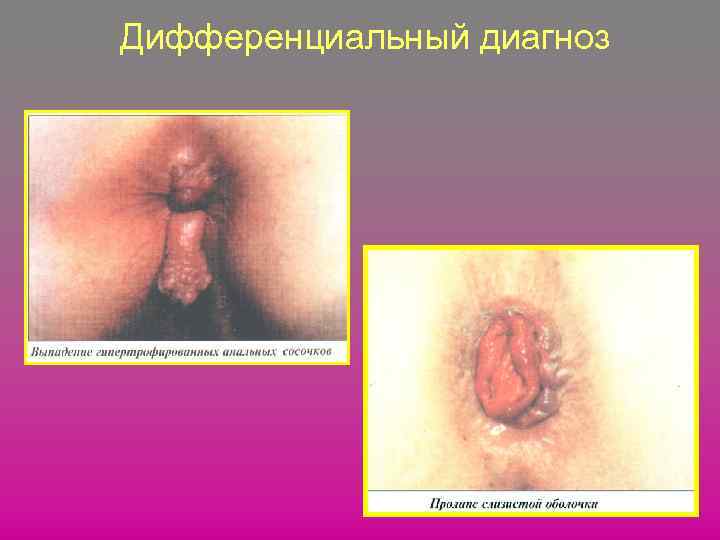 Дифференциальный диагноз 