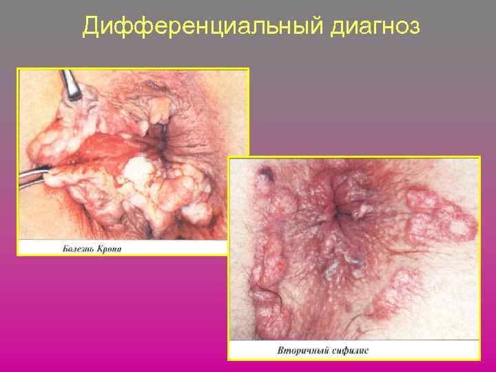 Дифференциальный диагноз 