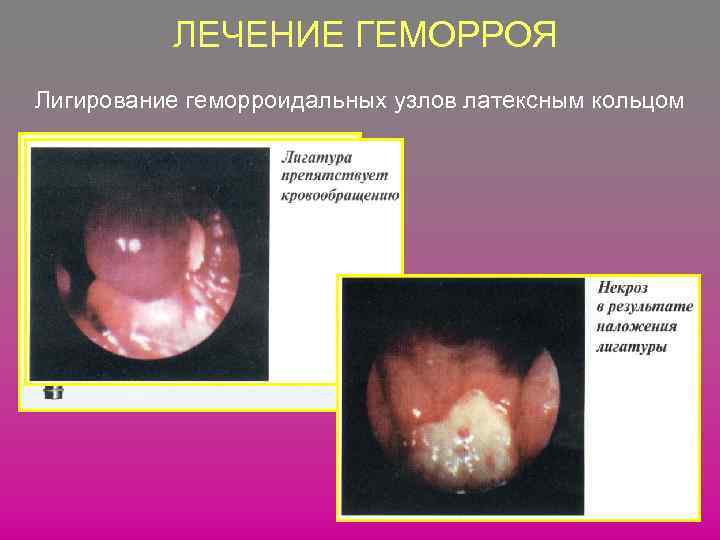 ЛЕЧЕНИЕ ГЕМОРРОЯ Лигирование геморроидальных узлов латексным кольцом 