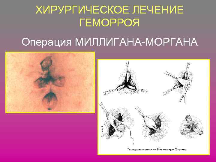 ХИРУРГИЧЕСКОЕ ЛЕЧЕНИЕ ГЕМОРРОЯ Операция МИЛЛИГАНА-МОРГАНА 