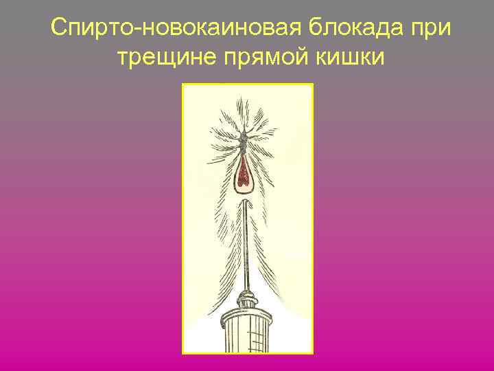 Спирто-новокаиновая блокада при трещине прямой кишки 