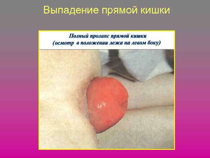 Выпадение прямой кишки 