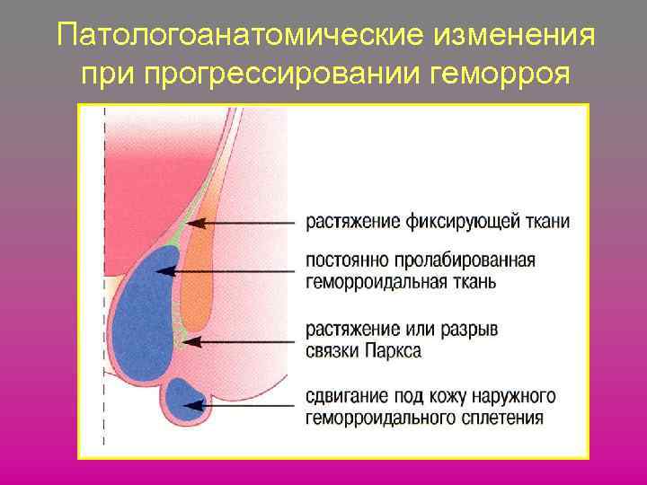 Патологоанатомические изменения при прогрессировании геморроя 