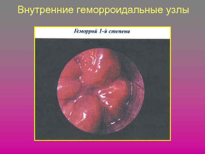Внутренние геморроидальные узлы 