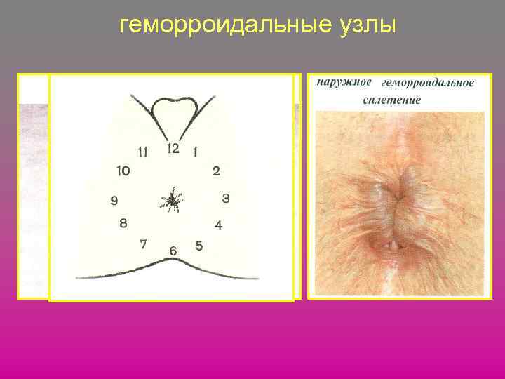 геморроидальные узлы 