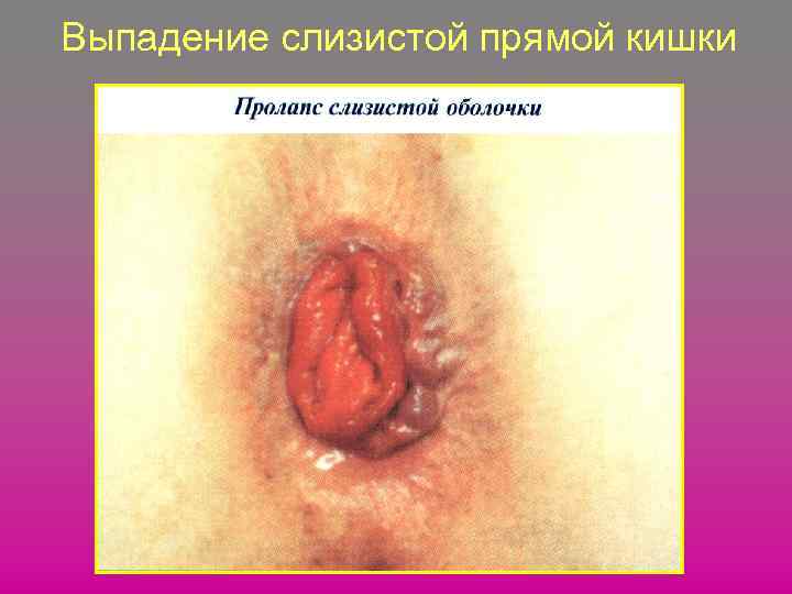 Выпадение слизистой прямой кишки 