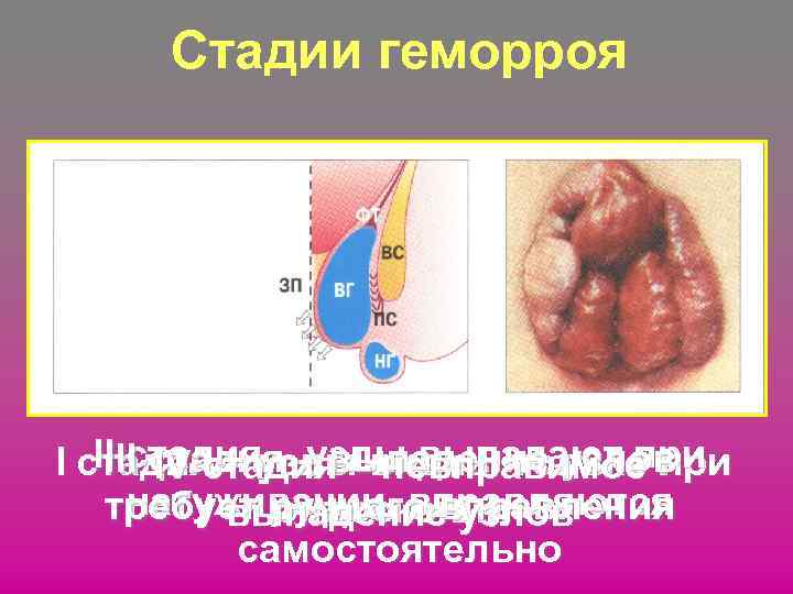 Стадии геморроя II стадия –– выпадение узлов III стадия узлы выпадают при I стадия