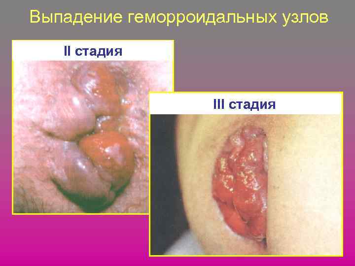 Выпадение геморроидальных узлов II стадия III стадия 