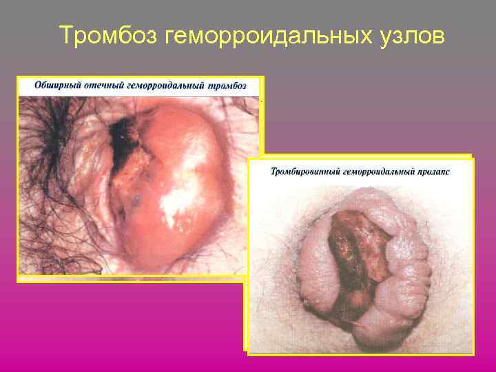 Тромбоз геморроидальных узлов 
