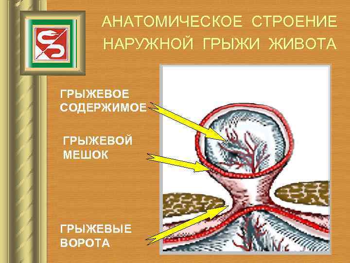 АНАТОМИЧЕСКОЕ СТРОЕНИЕ НАРУЖНОЙ ГРЫЖИ ЖИВОТА ГРЫЖЕВОЕ СОДЕРЖИМОЕ ГРЫЖЕВОЙ МЕШОК ГРЫЖЕВЫЕ ВОРОТА 