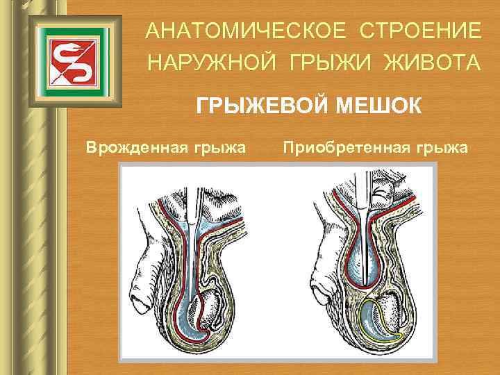 АНАТОМИЧЕСКОЕ СТРОЕНИЕ НАРУЖНОЙ ГРЫЖИ ЖИВОТА ГРЫЖЕВОЙ МЕШОК Врожденная грыжа Приобретенная грыжа 