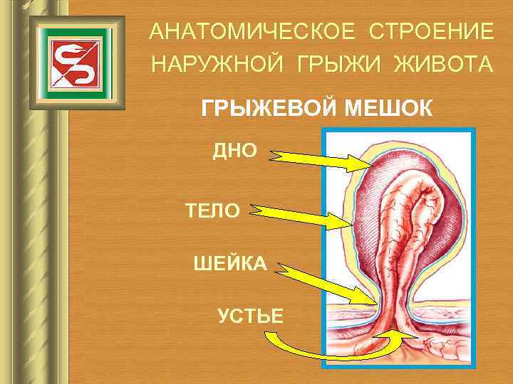 АНАТОМИЧЕСКОЕ СТРОЕНИЕ НАРУЖНОЙ ГРЫЖИ ЖИВОТА ГРЫЖЕВОЙ МЕШОК ДНО ТЕЛО ШЕЙКА УСТЬЕ 