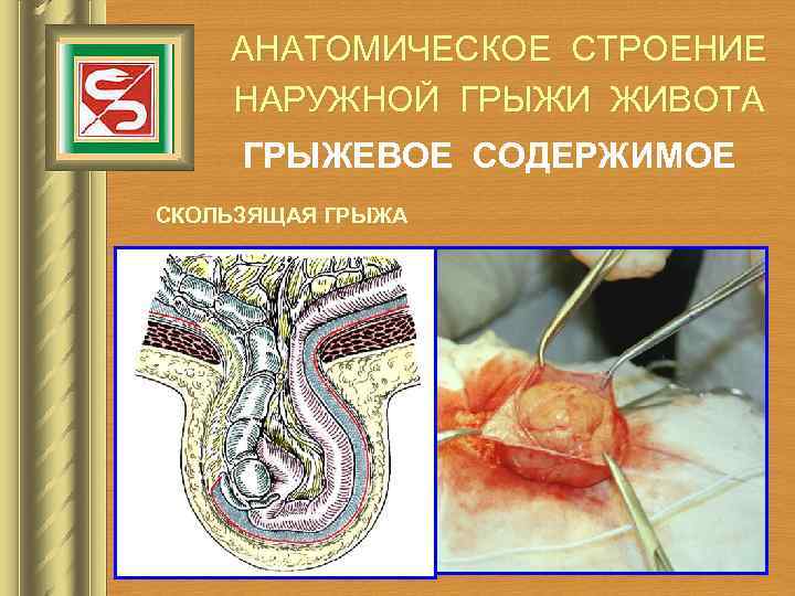 АНАТОМИЧЕСКОЕ СТРОЕНИЕ НАРУЖНОЙ ГРЫЖИ ЖИВОТА ГРЫЖЕВОЕ СОДЕРЖИМОЕ СКОЛЬЗЯЩАЯ ГРЫЖА 