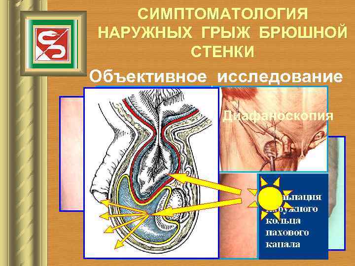 СИМПТОМАТОЛОГИЯ НАРУЖНЫХ ГРЫЖ БРЮШНОЙ СТЕНКИ Объективное исследование Диафаноскопия 